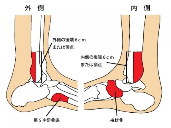高槻　橋本鍼灸整骨院　足の捻挫