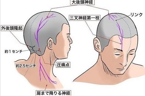 高槻　鍼灸　頭痛　橋本鍼灸整骨院