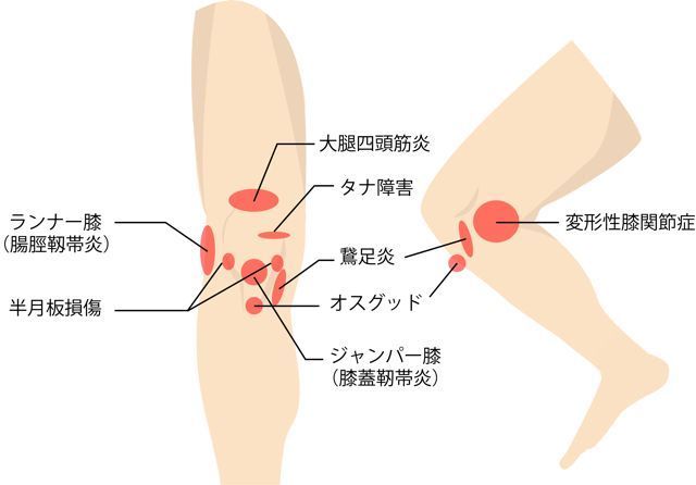 高槻　膝の痛み　症状